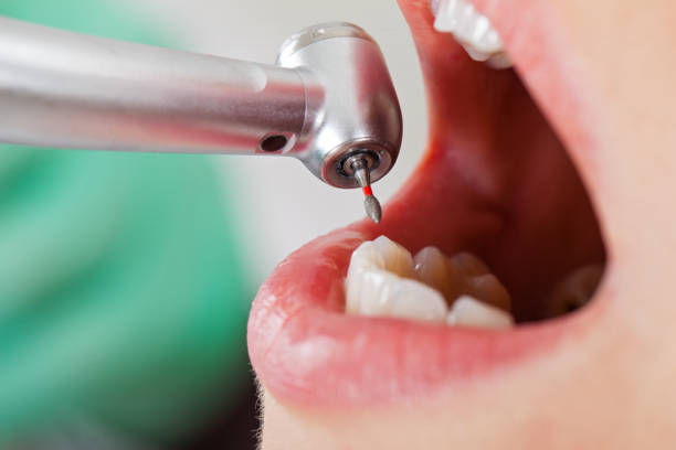 Best Emergency Wisdom Teeth Removal in Perry Park, CO
